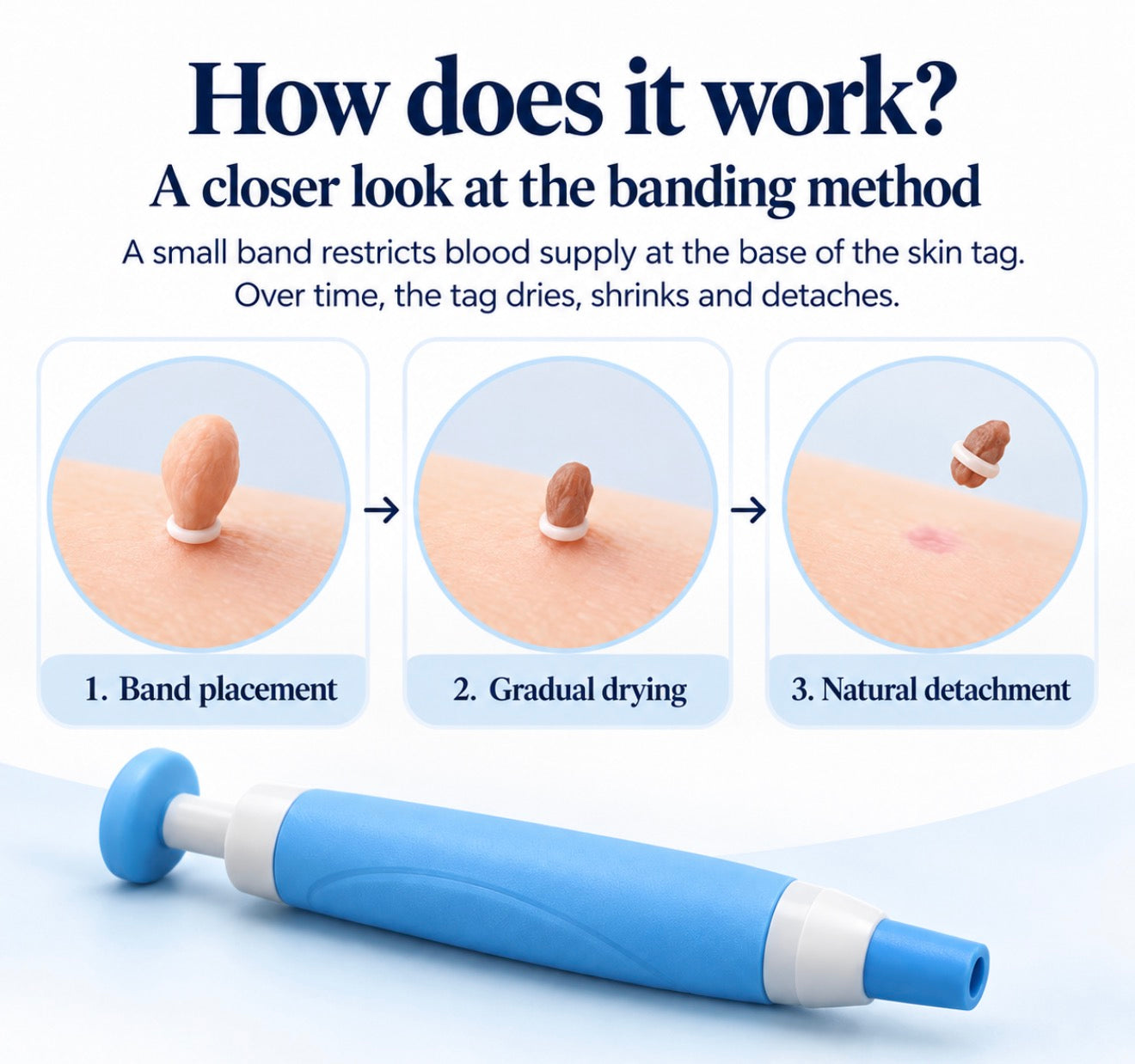 Skin tag removal set